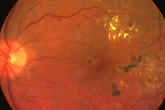 Early diabetic retinopathy 