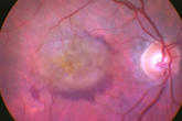 Age-related macular degeneration (AMD)