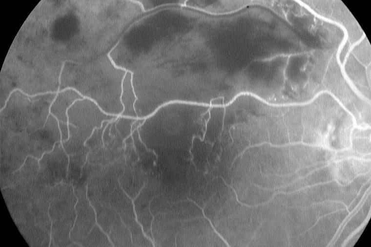 Netzhaut Erkrankungen Krankheitsbilder Augenklinik Stralsund